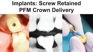 10 Implants Screw Retained PFM Crown Delivery [upl. by Pudendas]