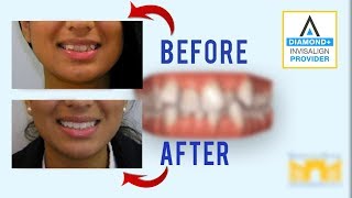 Invisalign Before and After Crowded Teeth [upl. by Anerys154]