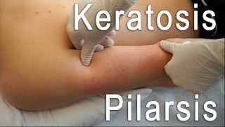 Keratosis Pilaris Clear  Brilliant Treatment FT Eric Smith  BLUSH Beverly Hills [upl. by Laemaj]