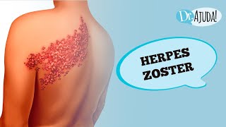 BOLHAS FERIDA E DOR O QUE É HERPES ZOSTER  Dr Ajuda [upl. by Conan693]