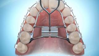 Hyrax Rapid Palatal Expansion Braces During [upl. by Beisel]