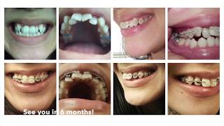 Adult braces timelapse 6 months [upl. by Prasad]