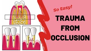 Trauma From Occlusion TFO  PERIODONTOLOGY [upl. by Nari]