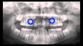 Serial Extraction Panoramic X Ray Time Lapse Kyger Orthodontics [upl. by Archy]