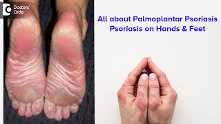 All about Palmoplantar Psoriasis  Psoriasis on hands amp feet  Dr Rajdeep Mysore  Doctors Circle [upl. by Kalil278]