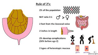 Meckel’s Diverticulum [upl. by Fennie]