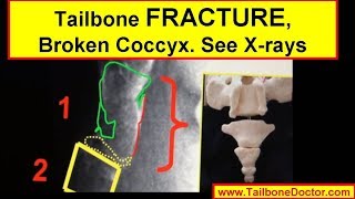 Xrays showing COCCYX FRACTURE broken tailbone [upl. by Rolat]