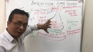 Interstitial lung diseasepathophysiology [upl. by Eiraminot]