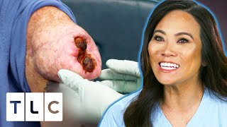 Dr Lee Removes An Open Wounded Lipoma  Dr Pimple Popper Pop Ups [upl. by Lily]