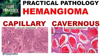 what is hemangioma [upl. by Yuji]