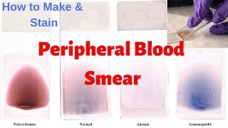 Peripheral Blood Smear Peripheral Smear Examination  Leishmans Staining Procedure [upl. by Docia210]