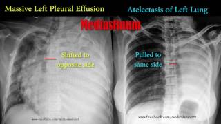 pleural effusion vs atelectasis [upl. by Athallia]