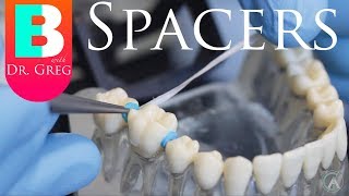 BRACES EXPLAINED Spacers [upl. by Tristas497]