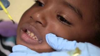 Provider Training Fluoride Varnish HD [upl. by Jacquelynn943]