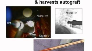 Spine Lecture How to Read a Cervical MRI [upl. by Karp972]