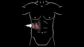 POCUS  Basic Renal Ultrasound [upl. by Linneman588]