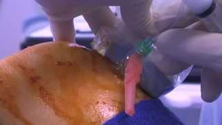 WATCH a Knee Joint Injection  LIVE [upl. by Neetsyrk]