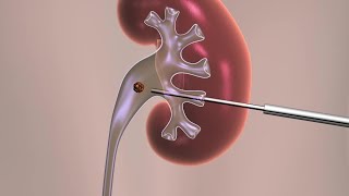 Percutaneous Nephrolithotomy [upl. by Salhcin]