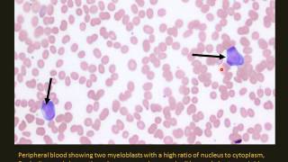 Leukemia What is leukemia  Norton Cancer Institute [upl. by Eryn]