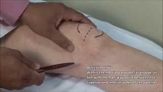 Knee Injection  Medial Approach [upl. by Naharba531]