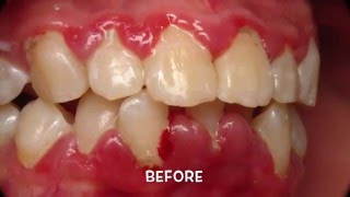 Treatment of Periodontal Gum Disease [upl. by Tama951]