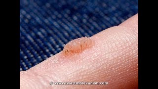 How to Remove Common Hand Warts  Wart amp Mole Vanish [upl. by Idnerb980]