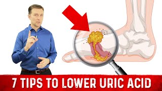 7 Tips to Lower Uric Acid – Dr Berg [upl. by Nytsua]