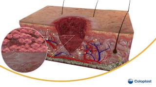 Wound Healing [upl. by Caton134]