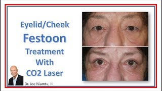 Festoon Treatment with CO2 Laser [upl. by Anivlis938]