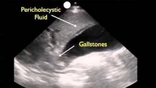 How To Gallbladder Ultrasound Part 3  Acute Cholecystitis Case Study Video [upl. by Xuaeb611]