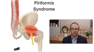 Piriformis Syndrome [upl. by Swithbert480]