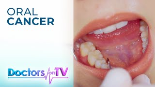 Oral cancer frequent asked questions about mouth cancer – Dentalk © [upl. by Melamed829]