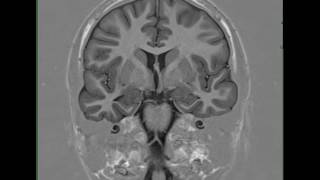 Mesial Temporal Sclerosis Right [upl. by Barbabas]