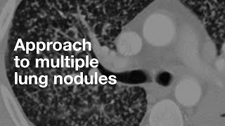 Understanding NonSmall Cell Lung Cancer [upl. by Iffar]