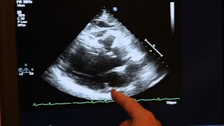 Echocardiogram Demonstration [upl. by Rumpf234]