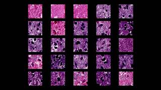 Oligodendroglioma GAN training sequence [upl. by Ecinev674]