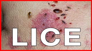 Pubic Lice or Crabs Info about Transmission Treatments Cure and Pictures [upl. by Ludewig]