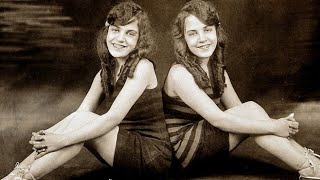 The Story Of The Conjoined Hilton Sisters [upl. by Anuaik]