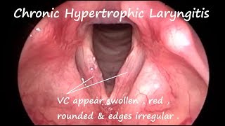 Rigid Videostroboscopy Procedure [upl. by Cataldo]