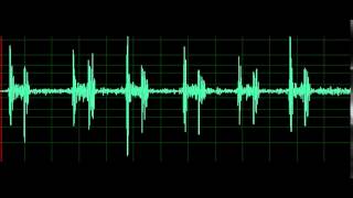 Pulmonary Associated Heart Sounds Tricuspid Regurgitation [upl. by Anieral]