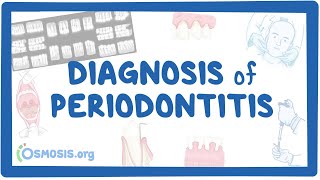 Diagnosis of Periodontitis [upl. by Frasier77]