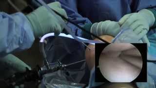 Arthroscopic Knee Surgery Meniscus Tear [upl. by Eada621]