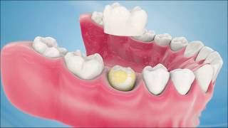 Dental Crown Procedure [upl. by Onia]