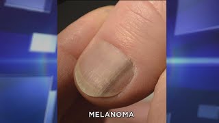 Subungual Melanoma What You Need to Know [upl. by Aryek923]