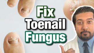 How to Treat Toenail Fungus CORRECTLY  Easy Steps 2021 [upl. by Buehrer]