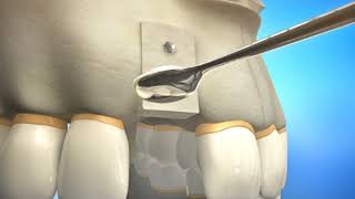 Bone Grafting Procedure Video Animation  Durham Dental Solutions [upl. by Yukio]