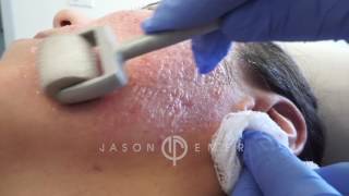 Dermaroller  Microneedling Acne Scars  Skin Resurfacing  Los Angeles California [upl. by Atteniuq606]