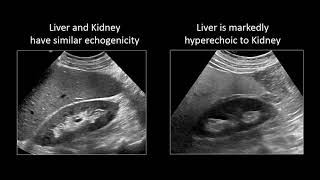 GI Imaging  Hepatic Steatosis and Cirrhosis [upl. by Yeslah]