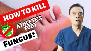 How to kill athletes foot fungus [upl. by Tellford225]