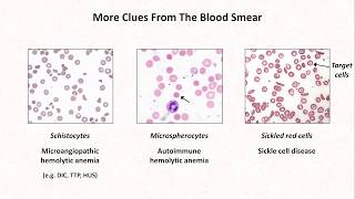 Anemia Lesson 4  Clues from the blood smear [upl. by Shalne]